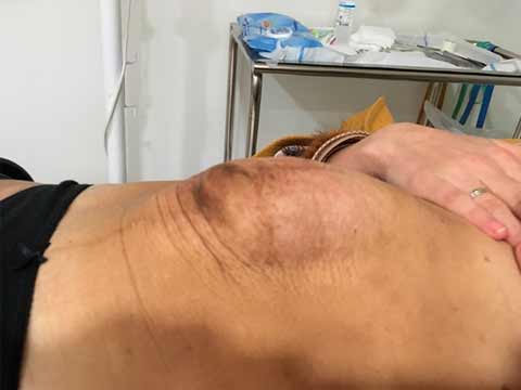Diástasis de los músculos rectos abdominales