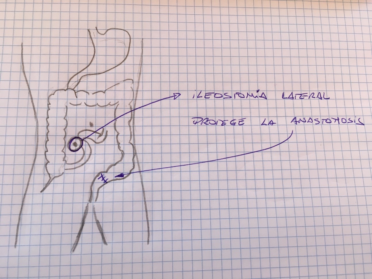 ileostomia lateral