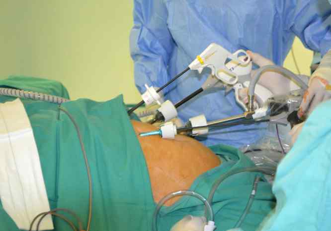 Intervención quirúrgica por laparoscopia