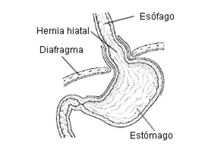 Reparación de hernia hiatal durante manga gástrica