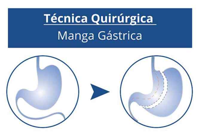 cirugia de la obesidad-manga-gastrica