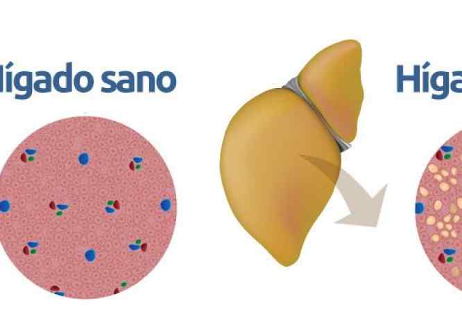 esteatosis hepática no alcohólica