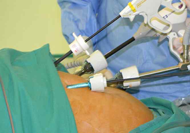 ¿Cómo se realiza una laparoscopia?